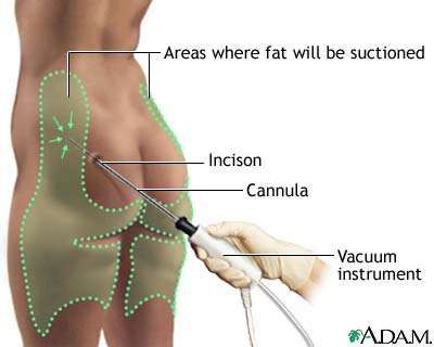 liposuction diagram