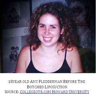 liposuction surgery gone wrong