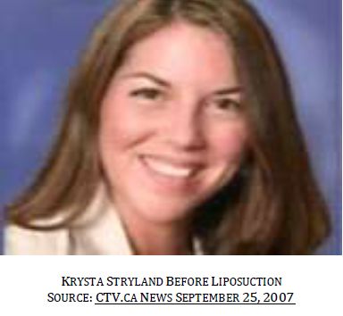 liposuction death