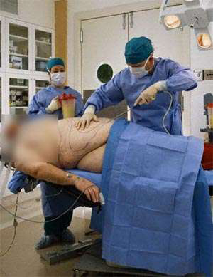 liposuction surgery